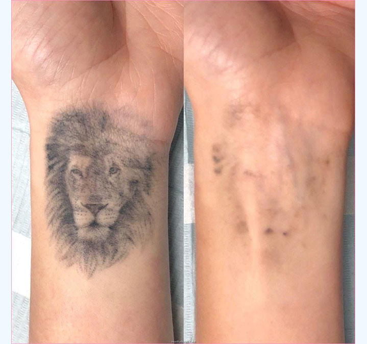 Tattoo-remove-images