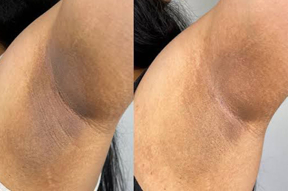 Underarms Peel Treatment