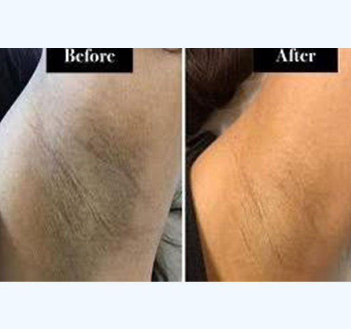 Under-amrs-peel-images-01