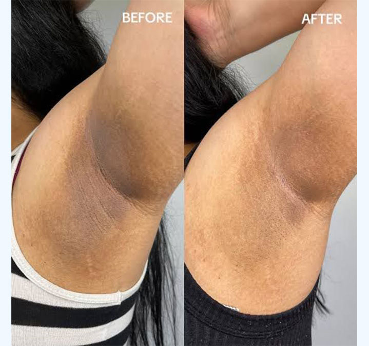 Under-amrs-peel-images-02