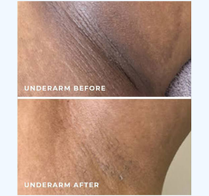 Under-amrs-peel-images-03