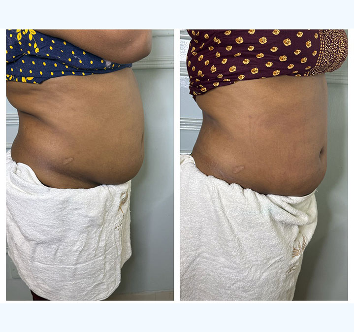 Belly-slimming-&-shaping-02