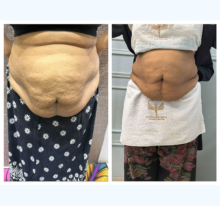 Belly-slimming-&-shaping-03