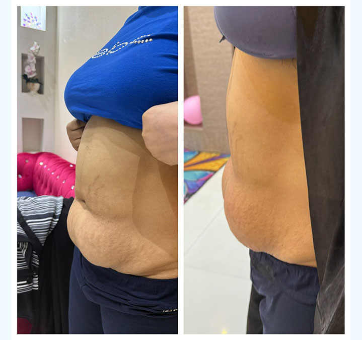 Belly-slimming-&-shaping-04