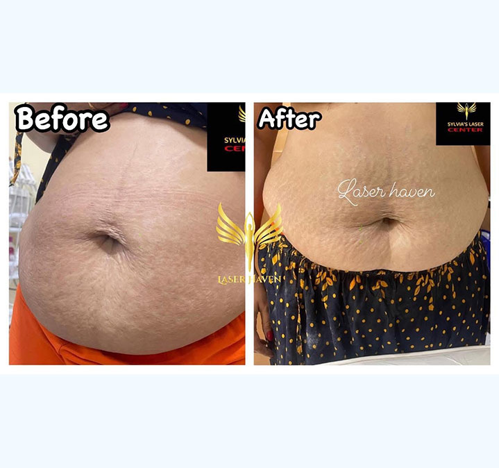 Belly-slimming-&-shaping-05