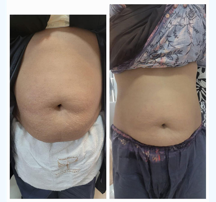 Belly-slimming-&-shaping-06