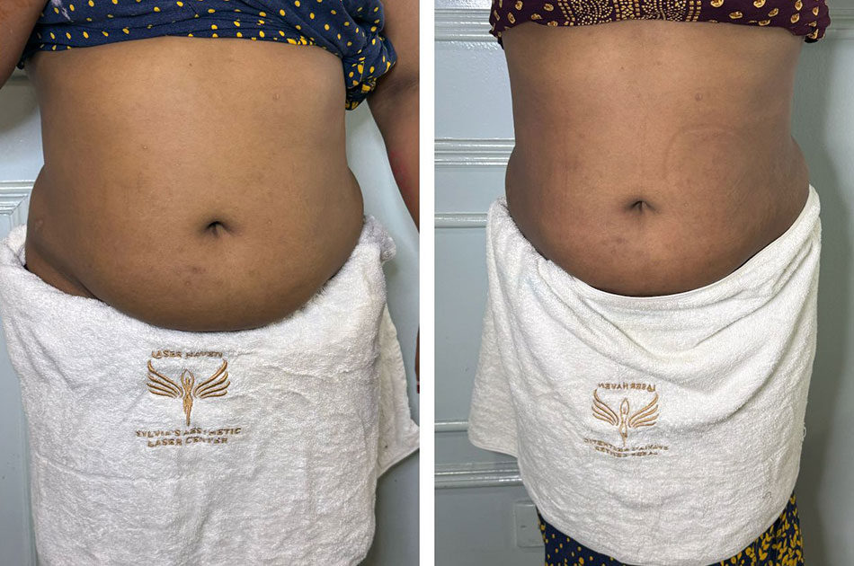 Belly Slimming & Shaping