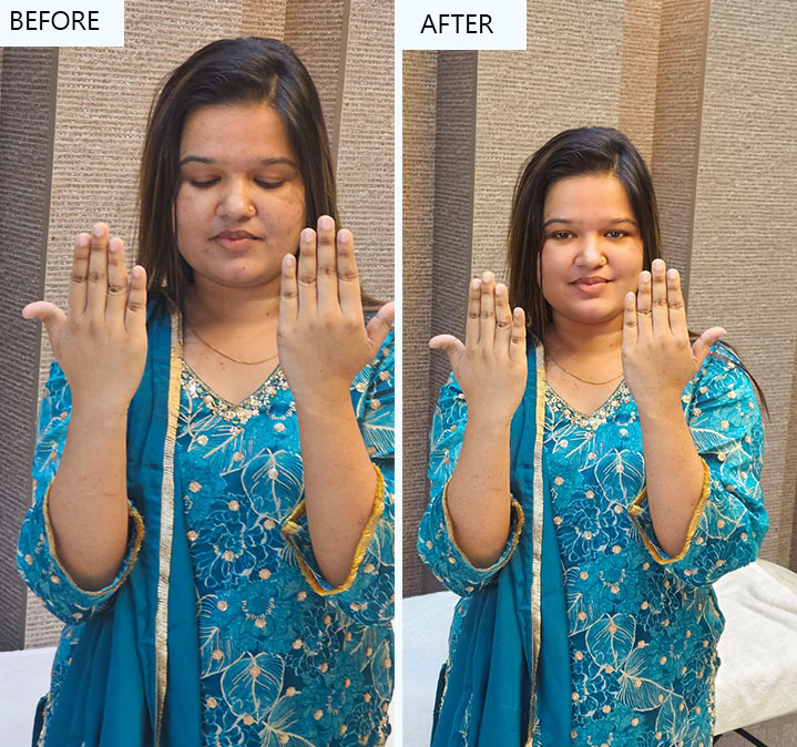 Glutathione-&-face-prp-images-03