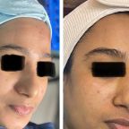 Skin-glow-treatment-image-01