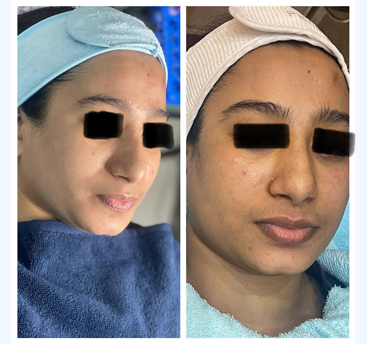 Skin-glow-treatment-images..