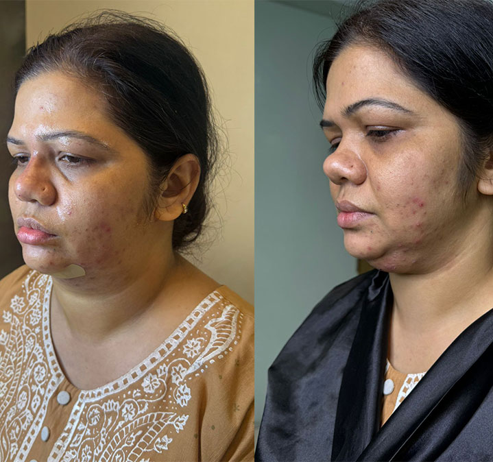 Double-chin-remove-01