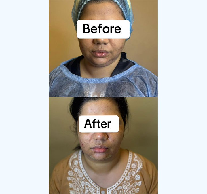 Double-chin-remove-03