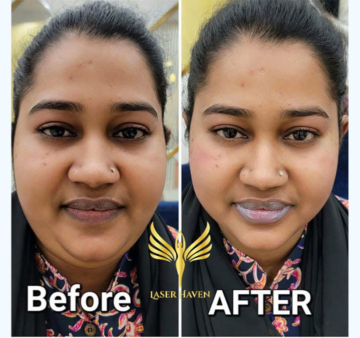 Double-chin-remove-04