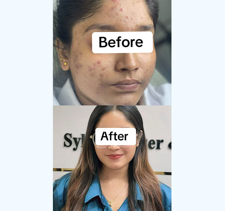 Double-chin-remove-05