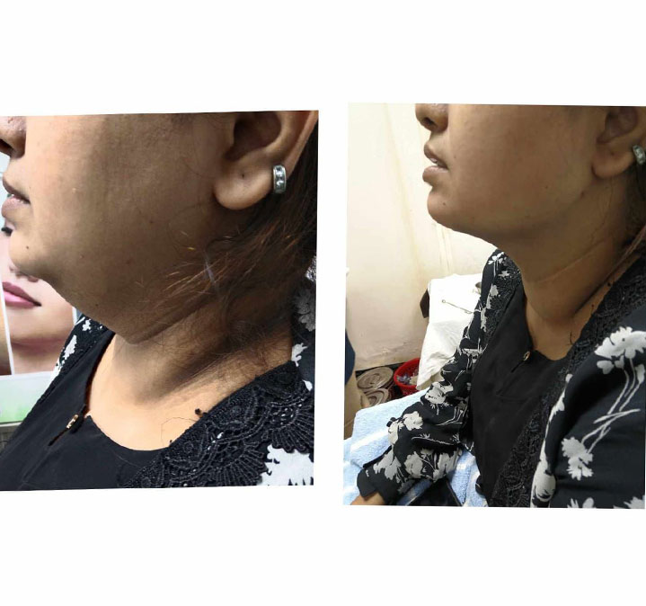 Double-chin-remove-06