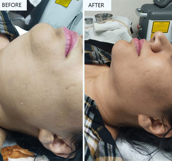 Double-chin-remove-07