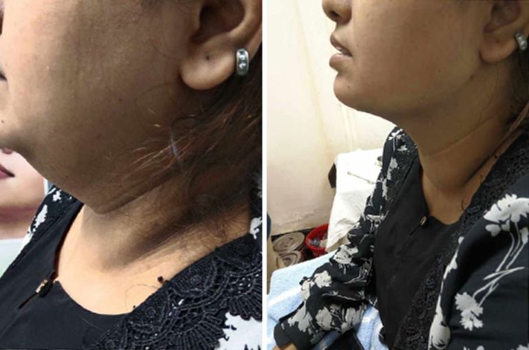 Double-chin-remove-images...