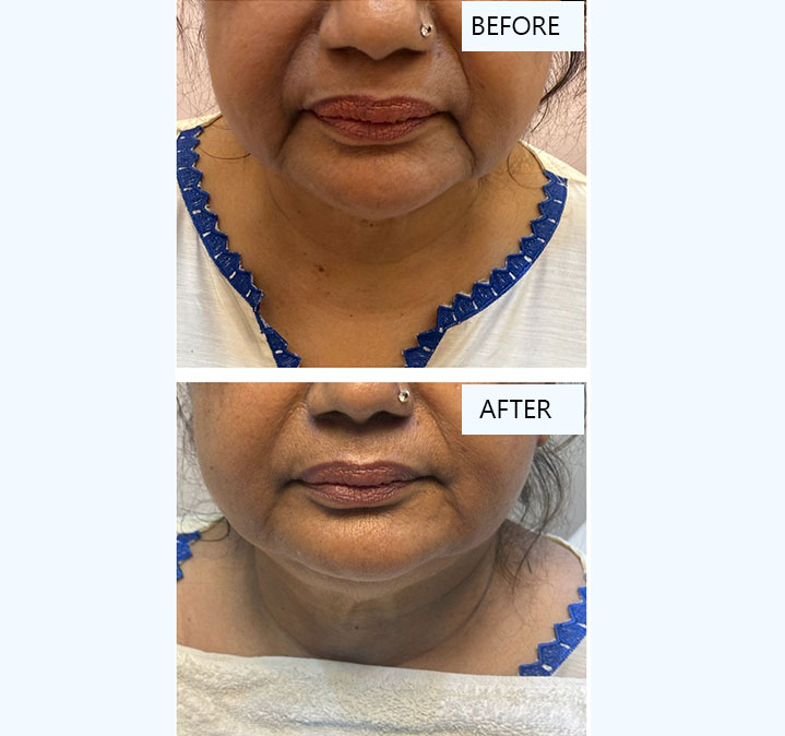 Filler-treatment-images-01