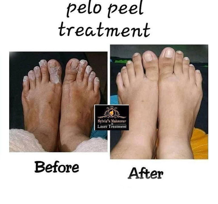 Foot-peel-images-01