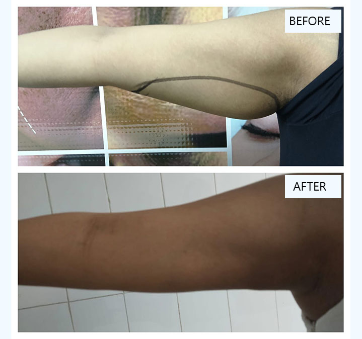 Hand-Slimming-images-01