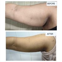 Hand-Slimming-images-02