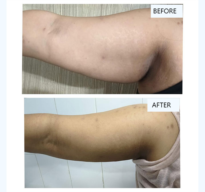 Hand-Slimming-images-02