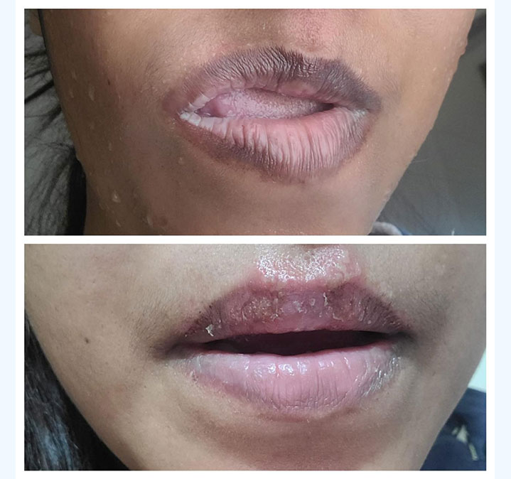 Lips-peel-images.-01