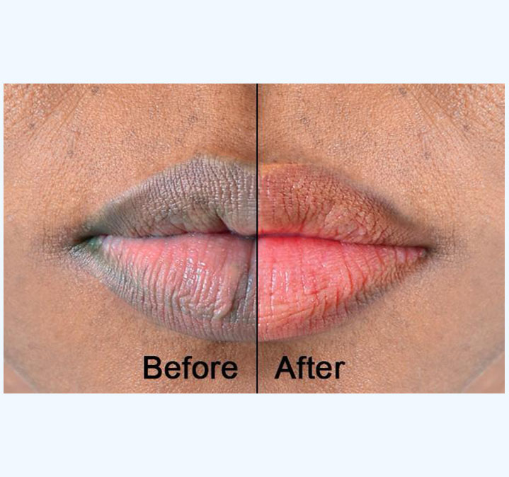 Lips-peel-images.-02