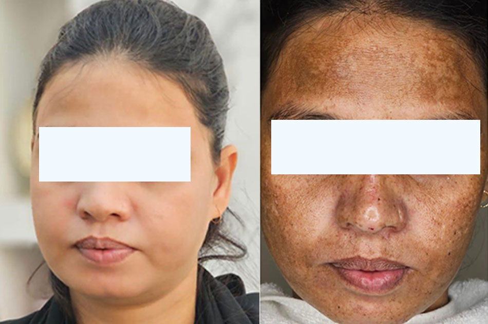 Melasma Treatment