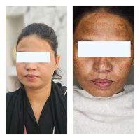 Melasma-Treatment-02