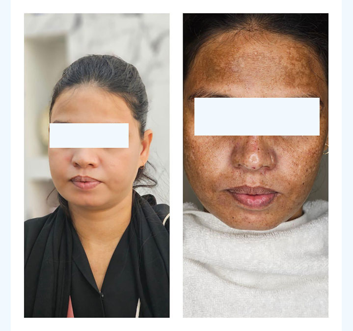Melasma-Treatment-02
