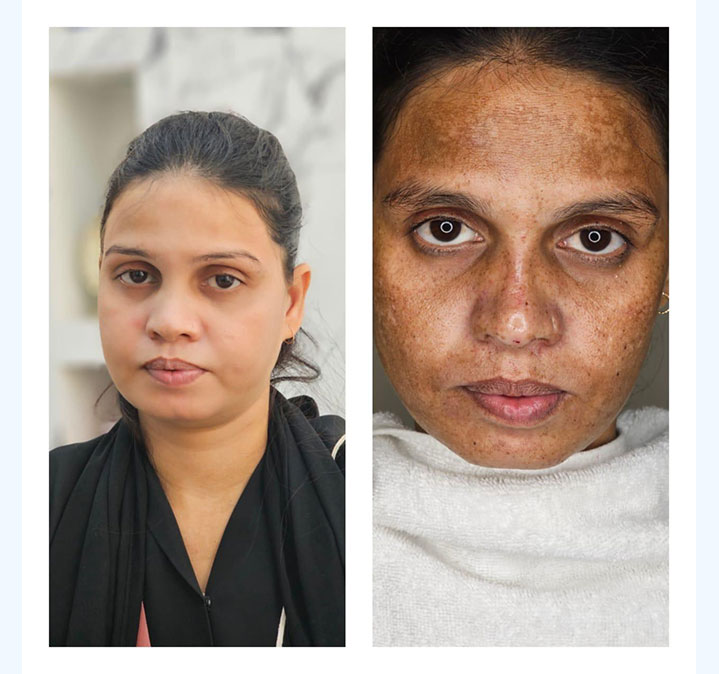 Melasma-Treatment-images-01