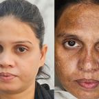 Melasma-Treatment-images