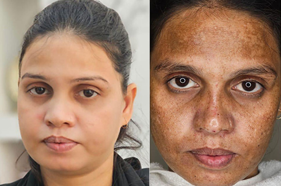 Melasma Treatment