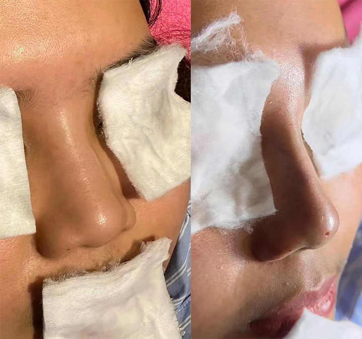 Nose-Shapes-images-01