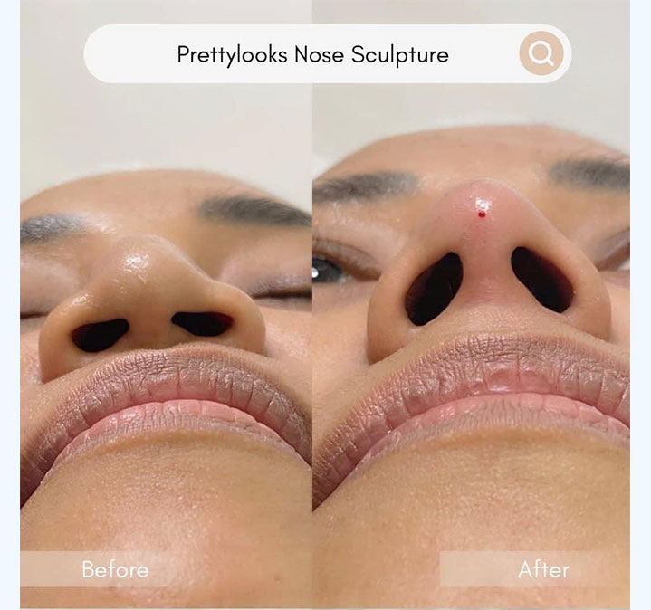 Nose-Shapes-images-03