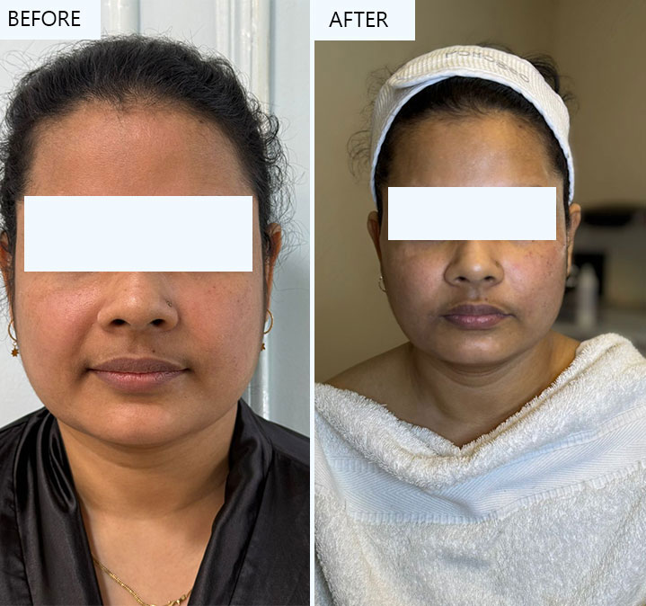 Face-Shaping-Treatment---01
