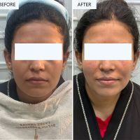 Filler-Treatment-01