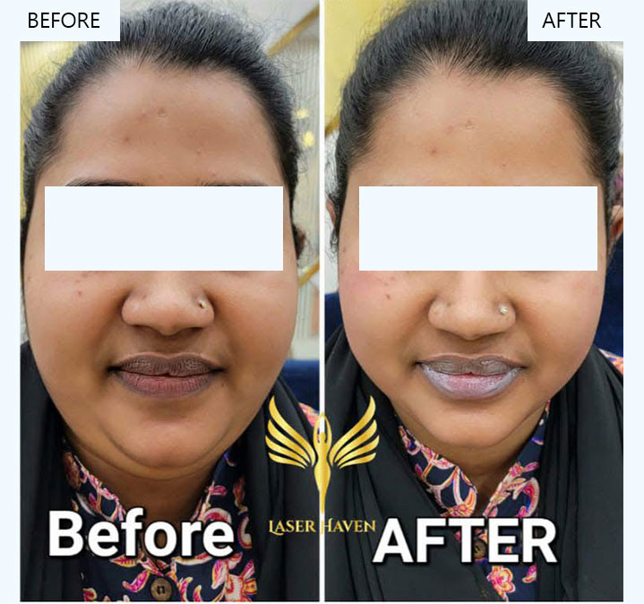 Glutathione-Treatment---01