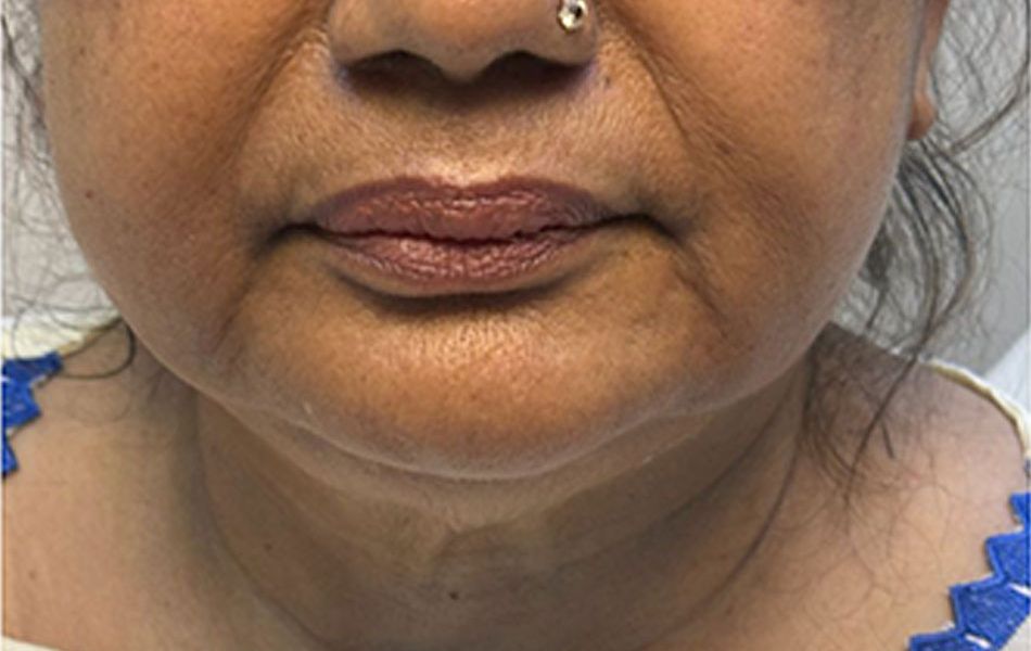 Filler-treatment-images...