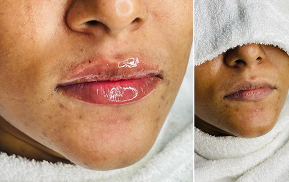 Lips-Filter-images--01