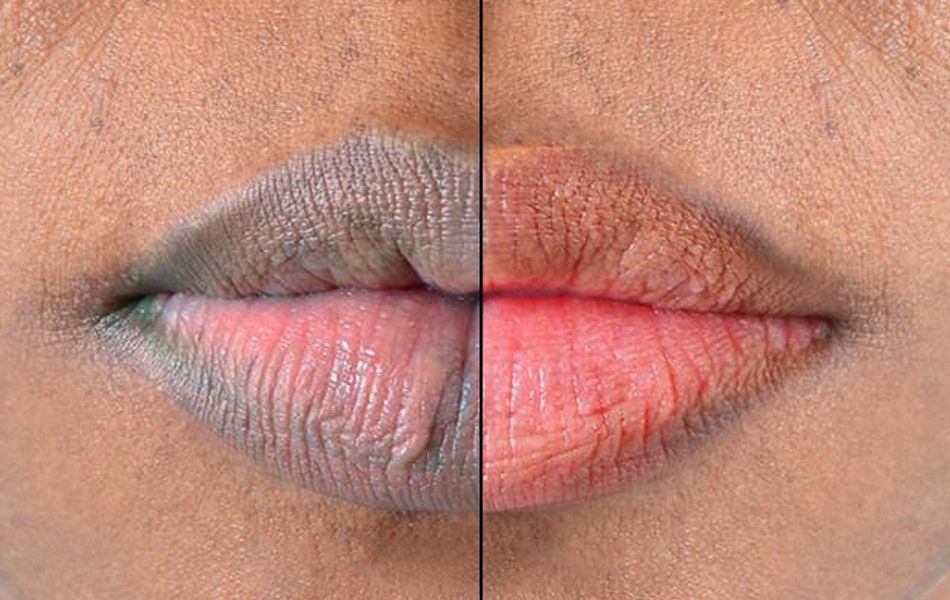 Lips-peel-images...
