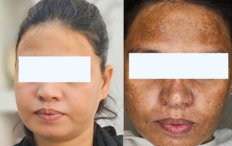 Melasma-Treatment-01
