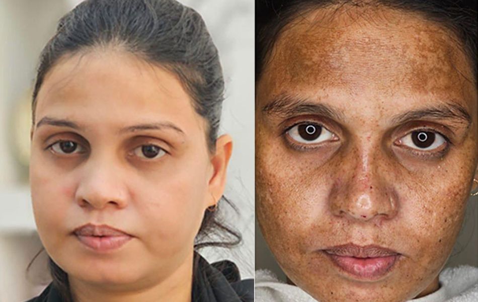 Melasma-Treatment-images