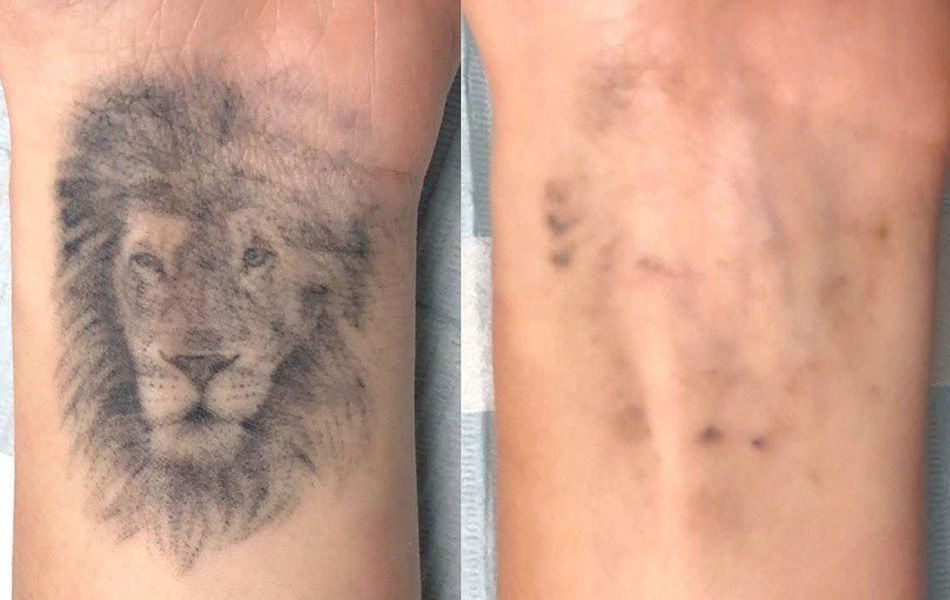 Tattoo-remove-images-1
