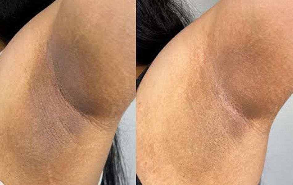 Under-amrs-peel-images-.....