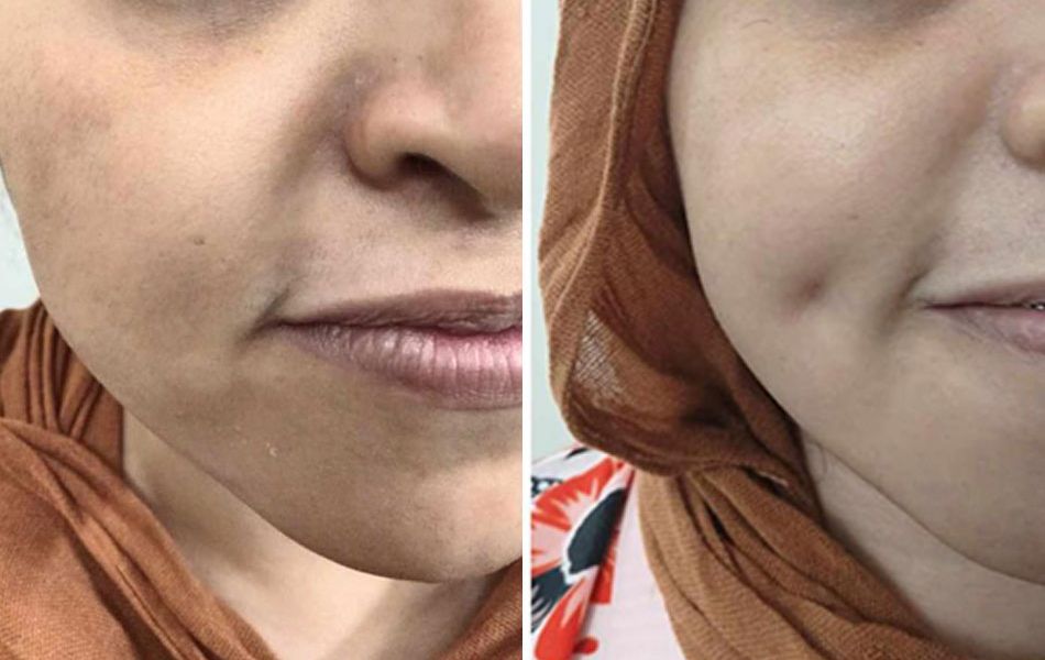 dimple-surgery-images